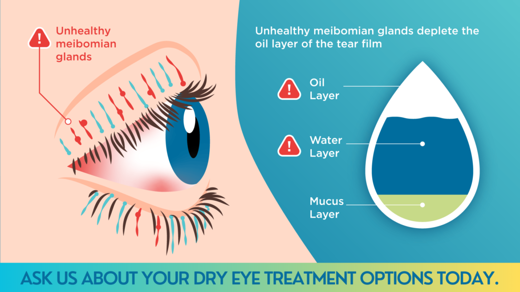 Dry Eye Treatment Spectrum Optical in WV