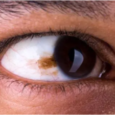 A dark brown spot, known as an eye freckle, is shown on the sclera.